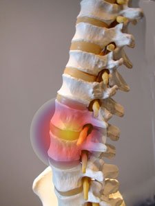 Low Back Pain 2