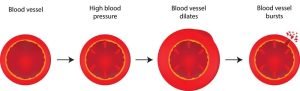 high blood pressure Aneurism