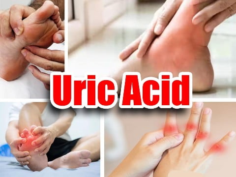 Uric Acid Home Remedies